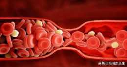 怎麼知道血管堵不堵？吃什麼食物能疏通血管？
