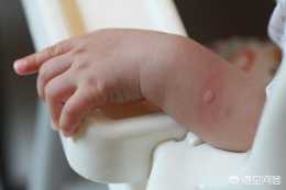 4歲寶寶得了蟲咬皮炎應該怎麼辦？