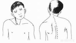 痙攣性斜頸會導致頭抖嗎？