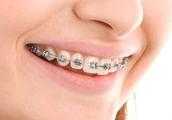 牙齒矯正會有副作用嗎？