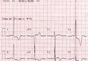入職體檢心電圖竇性心律，左心室高電壓影響入職嗎？