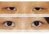 上瞼下垂的症狀是什麼？