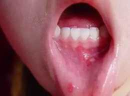 口腔潰瘍為什麼總復發？