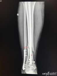 左小腿脛腓骨骨折五十天了，做內髓內釘怎麼鍛鍊？