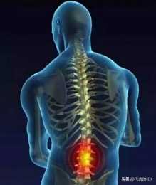 腰椎間盤突出部分脫出是啥症狀？