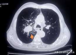 70歲得了肺癌能活多久？