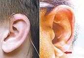 耳垂上有皺紋會和動脈硬化有關係嗎？