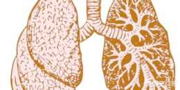 引發“蜂窩肺”的病因都有什麼？