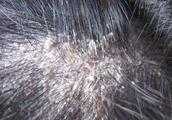 頭皮脂溢性皮炎要怎麼解決？日常頭髮護理要怎麼做才好呢？
