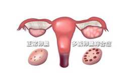 卵巢囊腫可以生小孩嗎？