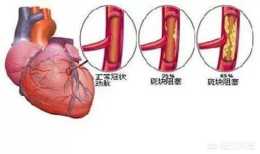 心室全部正常會有梗塞嗎？