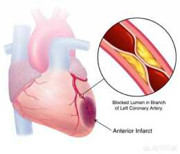 心臟病和心梗有哪些症狀，該如何預防呢？
