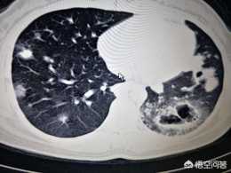 早期肺癌發展到晚期一般需要多久?