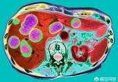 甲胎蛋白升高，與發生肝炎有關嗎？